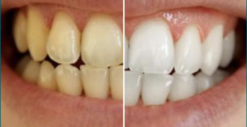 [Australia] - Ollie Teeth Whintening Strips 24 Strips, 12 Treatments, includes Shade Guide to Track Progress, Super Sticky Non - sensitive White Strips for Teeth Whitening 