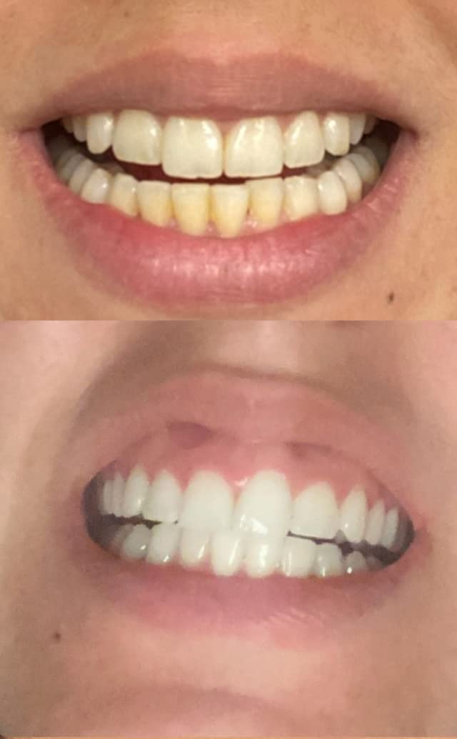 [Australia] - Teeth Whitening Kit with LED Light, 3 Carbamide Peroxide Teeth Whitening Gel Express Teeth Whitener. Remove Stains from Coffee, Smoking, Wine, Food (5 Piece Set) 3 Count (Pack of 1) 