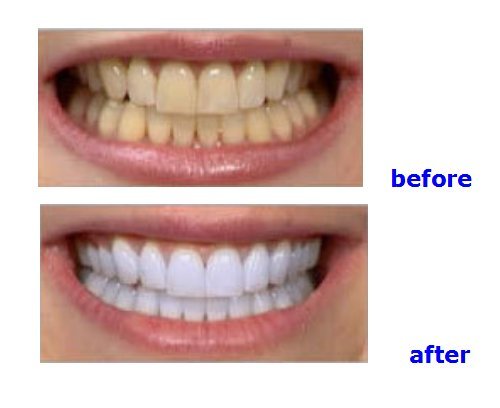 [Australia] - Professional De!ntal Portable Teeth Whitening Machine LED Bleaching Accelerator Light Lamp YS-TW-A 