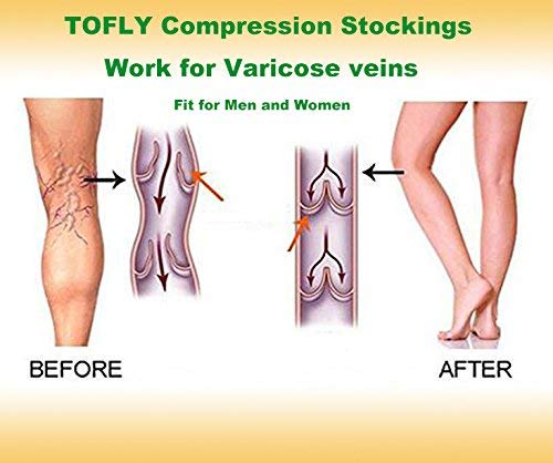 [Australia] - TOFLY¬Æ Compression Stockings (Pair), Grade Firm Support 20-30mmHg, Opaque, Unisex, Open Toe Knee High Compression Socks for Varicose Veins, Edema, Shin Splints, Nursing, Travel, Beige L Large 20-30mmhg Open-toe Beige 