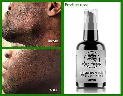 [Australia] - Pure Tropix Ingrown Hair Treatment & Prevention Kit - Razor Bump and Burn Remover - Bikini Lines & Acne - Use After Shaving, Hair Removal, Waxing, Laser, Electrolysis - for Men and Women (59ml) 