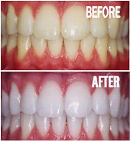 Bright White Smiles Teeth Whitening Gel Refill Kit, 10 44% Tubes | 44% Carbamide Peroxide, Tooth Whitener Formula