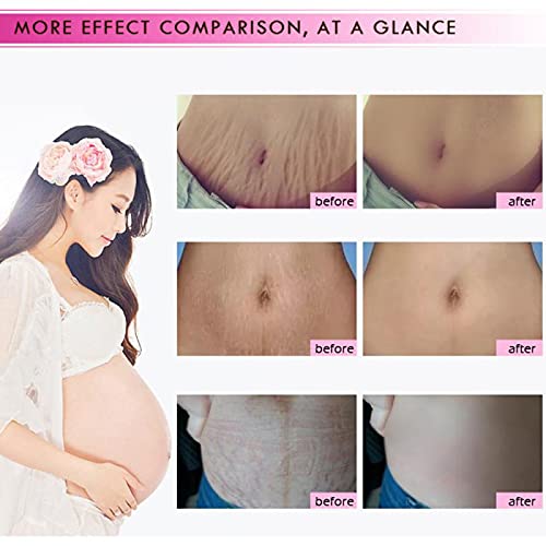 [Australia] - Mango Stretch Marks and Scar Cream, Stretch Marks and Scar Removal Cream for Pregnancy, Stretch Marks Scar Belly Creams for Wrinkles, Obesity Fat Stretch Mark Moisturizing, Remove Marks (40g) 