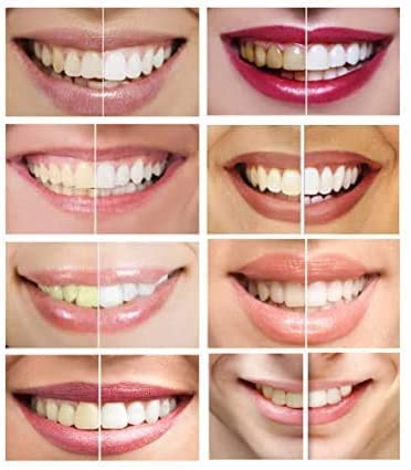 [Australia] - Pack of 10 Syringes of 10ml of Teeth Whitening 44% Gel 