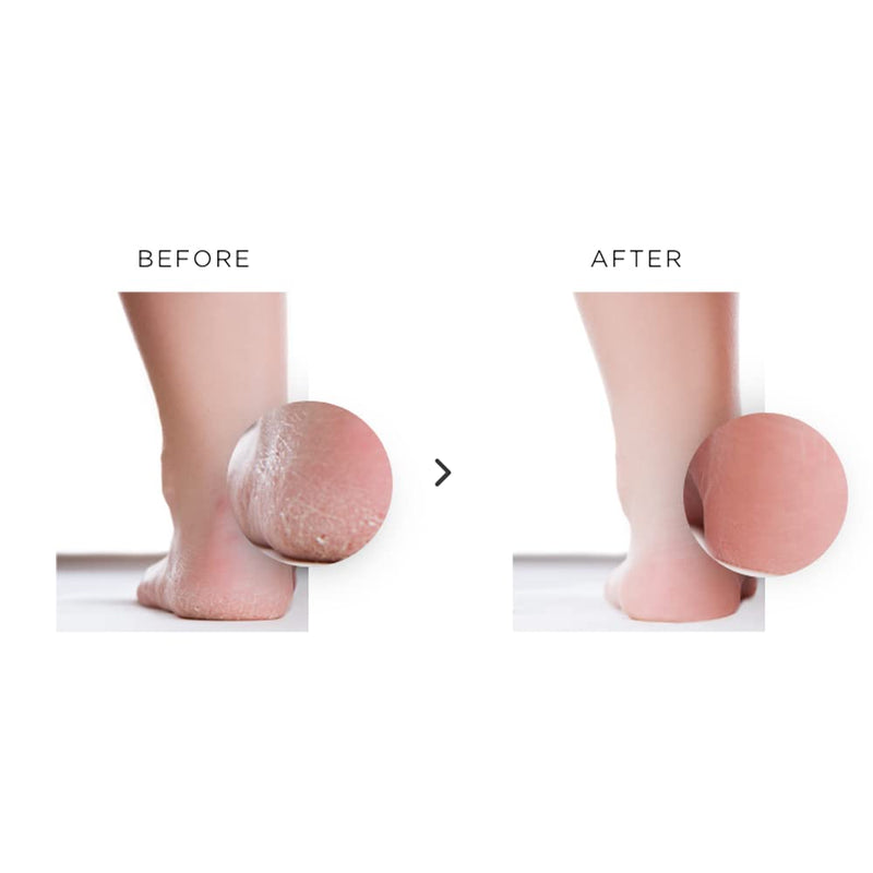 [Australia] - How to Remove Calluses & Dead Skin from Feet: nu119 Instant Foot Peeling Spray Gets Rid of Thick Callus on Feet Fast & Easy. Naturally Reduces & Softens Your Rough Feet Skin in Just Minutes at Home 