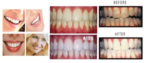 [Australia] - 5 XL 38% Teeth Whitening Gel Dentist Recommended High Intensity Carbamide Peroxide Pro Dental Lab Direct, Sensitivity Free, Sold by Dentists, Whiter Smile Labs Fast WHITENING Results 