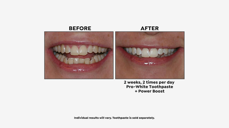 IntelliWHiTE Power Boost Daily Whitening Gel – Dentist Grade 5% Hydrogen Peroxide Teeth Whitening Gel, Simply Add to Toothpaste, Sensitive Teeth Safe, Enamel-Safe, Gum Care, 4 Month Supply