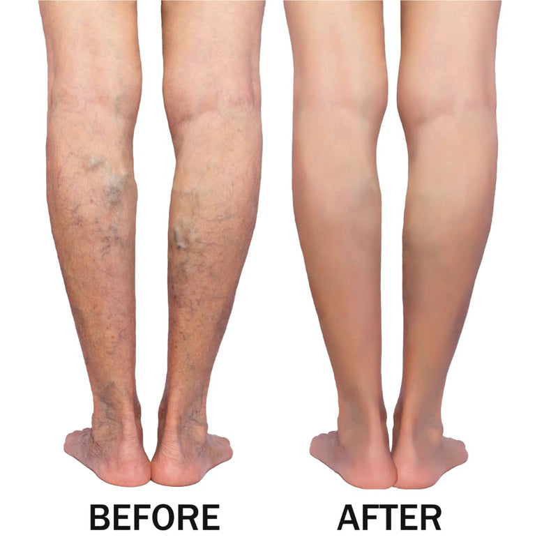 [Australia] - Green idea | HORSE CHESTNUT OIL for varicose veins, hemorrhoids, severe leg syndrome | Vein protective effect | with horse chestnut seed and flower extract - hemorrhoid oil 100 ml 