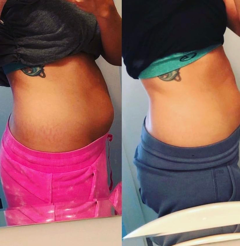 [Australia] - Promise Stretch Mark Prevention Kit, Scars and Dry Skin, Ultra-Hydrating Stretch Mark Cream and Stretch Mark Oil for Pregnant Women, Vegan, Non-Toxic, Set 