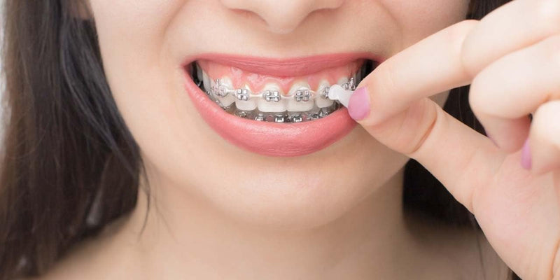 Genuine Orthowax - Orthodontic Wax for Braces Wearer - Stick Better Than competitors 9