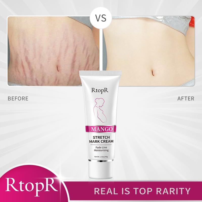 [Australia] - Stretch Mark Removal Cream, Obesity Stretch Mark Moisturizer, Postpartum Repair Stretch Mark Cream, Abdominal Stretch Mark Cream, Remove Marks (1 PCS) 1 PCS 