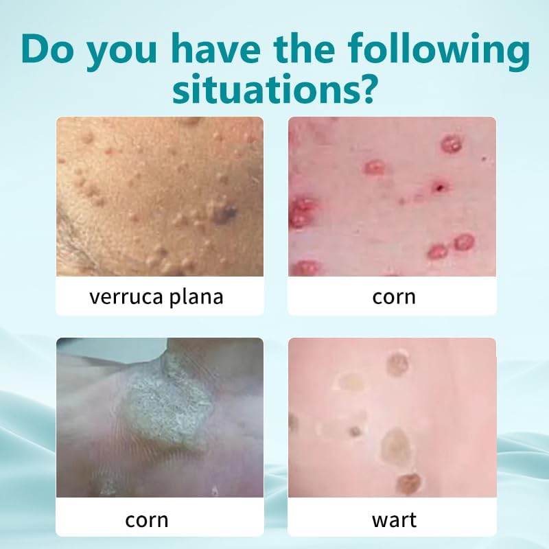 [Australia] - Maximum Treatment Liquid Corn Remover and Callus Remover for Fast-Acting Foot Care - Plantar and Common Callus Remover Treatment for Kids and Adults 