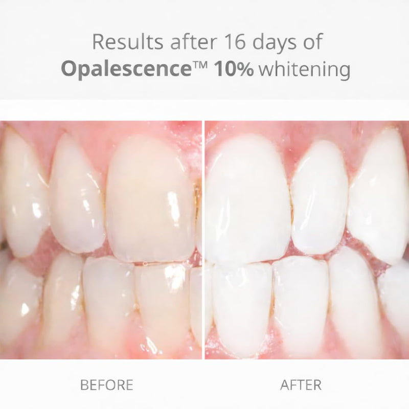 Opalescence 10% Teeth Whitening Gel Refill Syringes, (4CT) Melon 5395-2 | 10% Carbamide Peroxide Melon Whitening Gel for Custom Trays. Low-Sensitivity Formula, Dentist Developed and Made in USA.