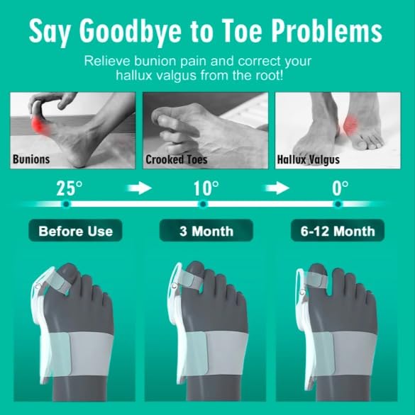 ALINO Bunion Corrector | Adjustable Toe Straightener for Men & Women | Toe Corrector with Rotating Knob, Universal Fit for Left & Right Foot | Leg Finger Straightener | Free Toe Exerciser