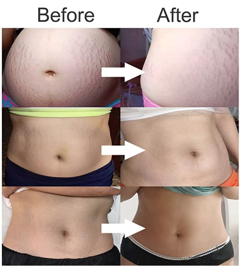 [Australia] - Stretch Mark Remover Cream, 120g/4oz Pregnancy Scar Cream Stretch Mark Removal Cream, Reduction & Prevention of Stretch Marks Mommy Belly Massage Body Butter Skin Care 