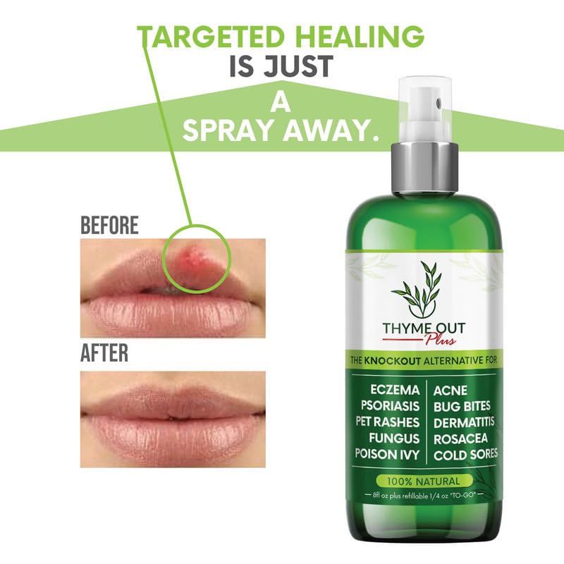 [Australia] - Plus Eczema Treatment, Psoriasis Treatment Treats Acne, Dermatitis, Rosacea, Cold Sores, Pet Rashes, Bug Bites, Poison Ivy, Anti Itch Spray for Itchy Skin Relief for Kids, Adult & Baby 8 Fl Oz (Pack of 1) 