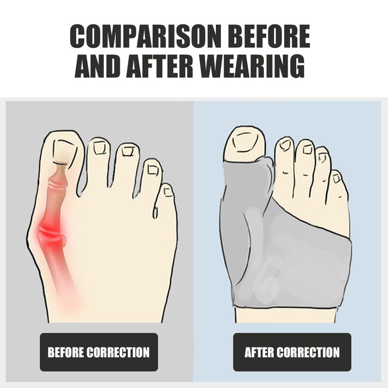 [Australia] - 2 pairs of hallux valgus socks with gel pad protection, hallux valgus correction, hallux valgus retractor, toe spreader, adjustable foot corrector, toe valgus spacer with silicone protection 