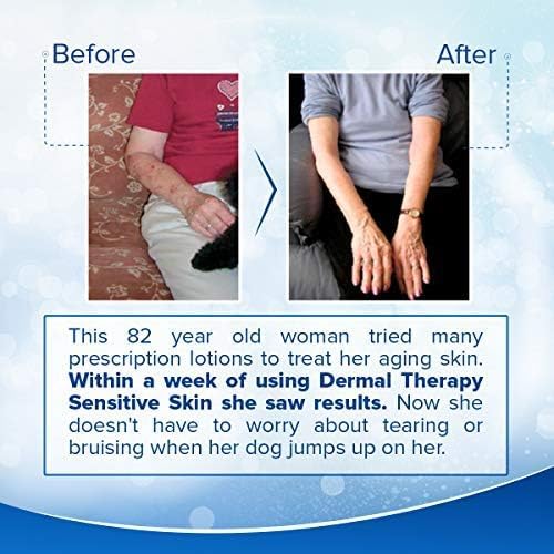Dermal Therapy Sensitive Skin Lotion - Non-Irritating Lotion with 15% Allantoin, 10% Shea Butter, Vitamin E