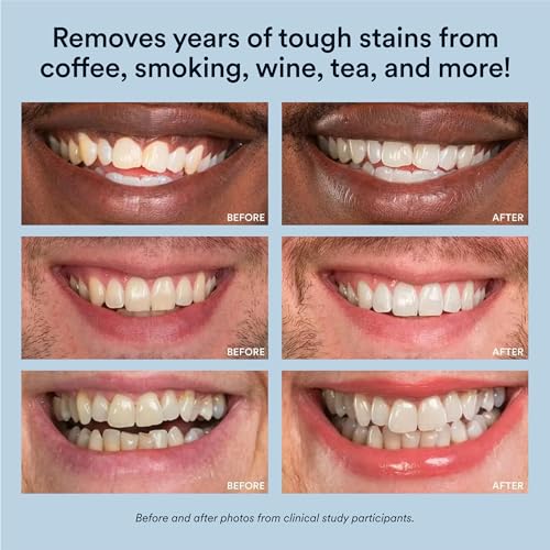 Auraglow Teeth Whitening Kit with LED Light & Extra Strength 44% Carbamide Peroxide Teeth Whitening Gel Refill, 30+ Treatments, Whiten Up to 10 Shades