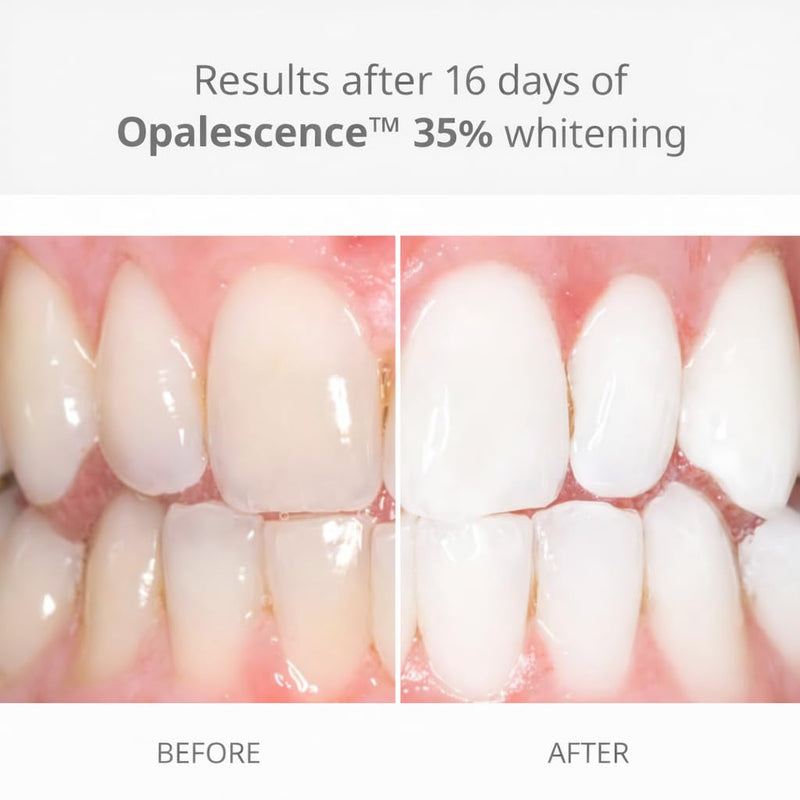 Opalescence 35% Teeth Whitening Gel Refill Syringes, with PF (4ct) 5404-2 | 35% Carbamide Peroxide Whitening Gel for Custom Trays. Low-Sensitivity Formula, Melon, Dentist Developed and Made in USA. 0.04 Fl Oz (Pack of 4)