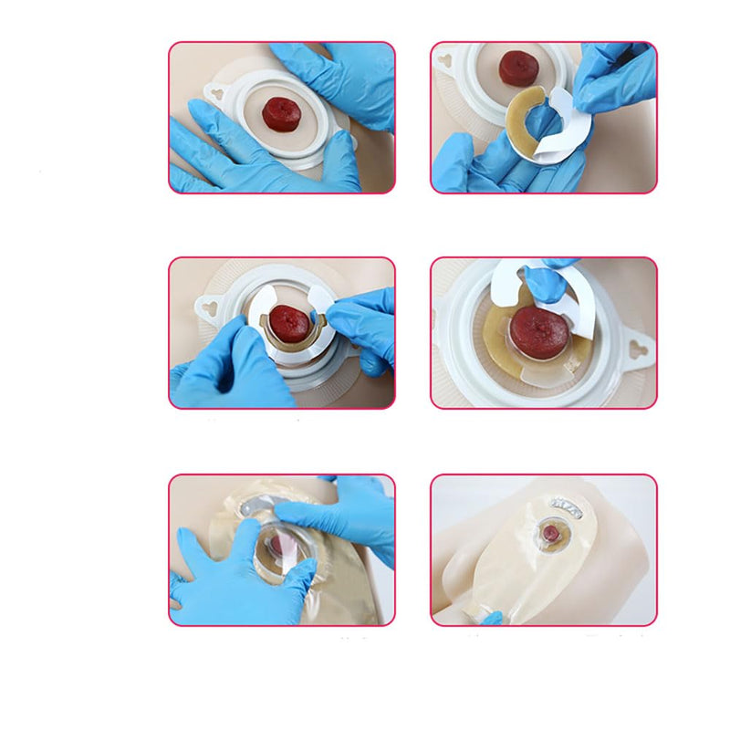 20PCS Upgraded Skin Barrier Ring with Directional Flow Ostomy Supplies Customizable Skin Barrer Ring 2mm 6012-2mm