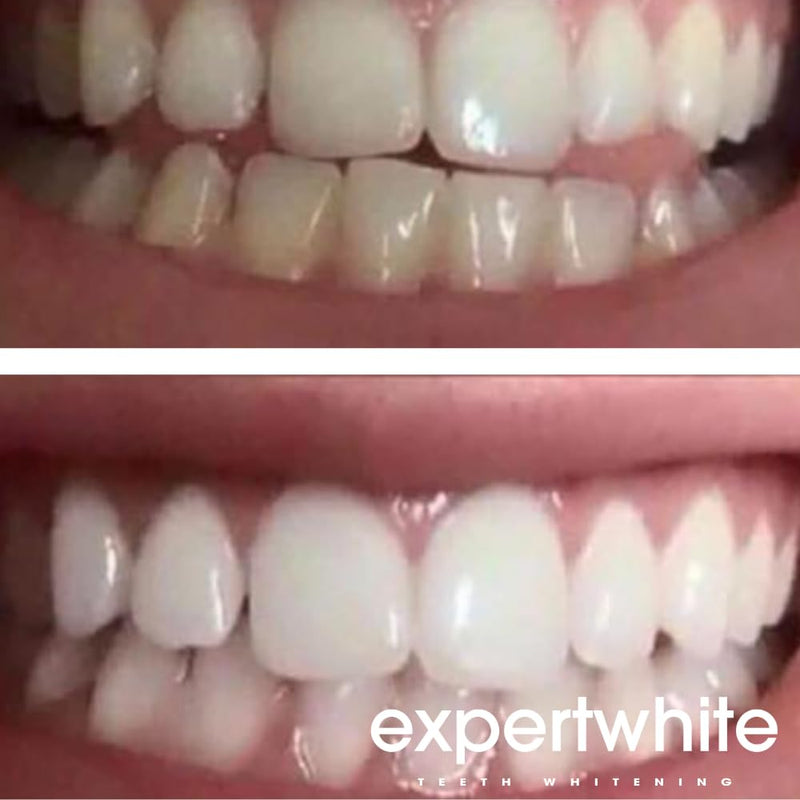 44% Teeth Whitening Gel - Refills for Trays – Professional Strength Carbamide Petoxide Syringes, 4 × 3cc, 15-Minute Treatment, Gels Only (No Trays)