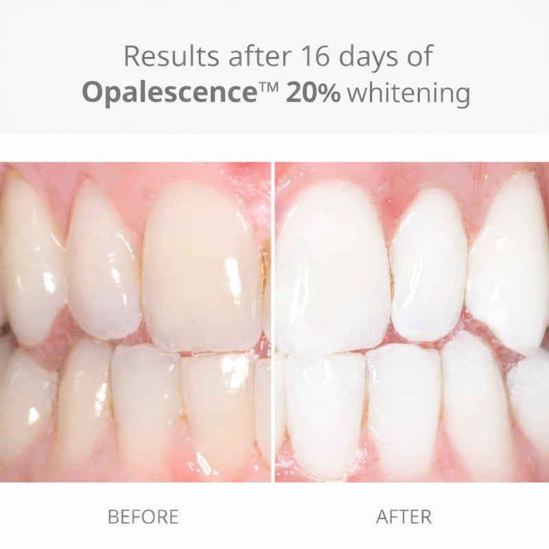 Opalescence 20% Teeth Whitening Gel Refill Syringes, with PF (4ct) 5401-2 | 20% Carbamide Peroxide with Potassium Fluoride Melon Whitening Gel for Custom Trays. Low-Sensitivity Formula. Made in the USA 1 Count (Pack of 4) Melon 20