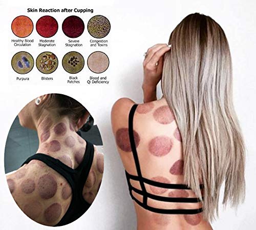 [Australia] - Cupping Set Professional Chinese Acupoint Cupping Therapy Sets Portable, Suction Hijama Cupping Set with Vacuum Magnetic Pump Cellulite Cupping Massage Kit 22-Cup 