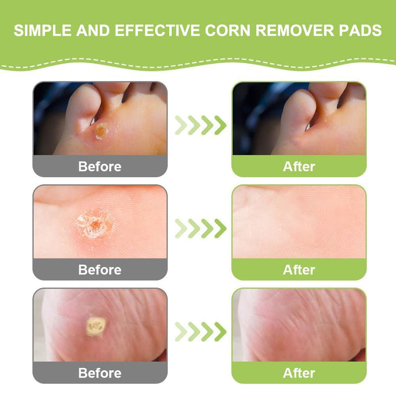 [Australia] - Corn plaster, 30 pieces corn removal pads, corn removal plaster, corn removal on the sole of the foot, corn remover pads, corn removal plaster 