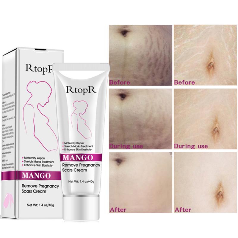 [Australia] - Mango Stretch Marks and Scar Cream, Stretch Marks and Scar Removal Cream for Pregnancy, Stretch Marks Scar Belly Creams for Wrinkles, Obesity Fat Stretch Mark Moisturizing, Remove Marks (40g) 