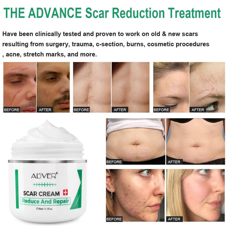 [Australia] - Scar Cream, Scar Serum, Stretch Marks Removal Skin Repair Cream Scar Removal Cream Scar Removal Cream the skin to improve the skin contour 