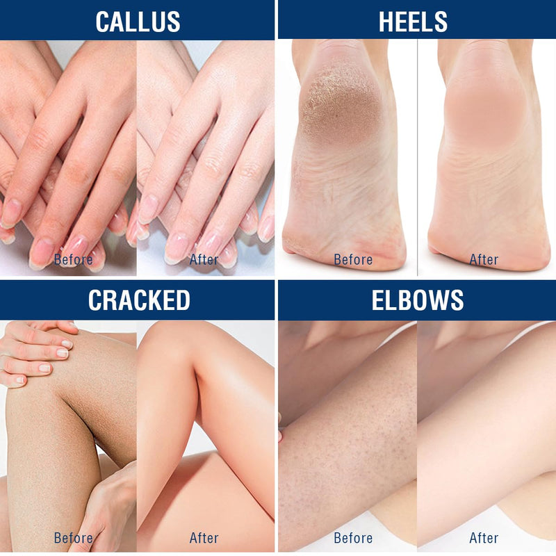 OUKEYA Urea Cream 40% with 2% Salicylic Acid, 12.35 Ounce 12.35 Ounce (40% +2% Urea Cream)