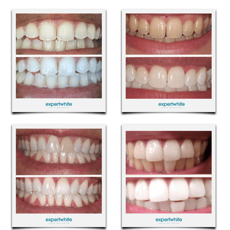 44% Teeth Whitening Gel - Refills for Trays – Professional Strength Carbamide Petoxide Syringes, 4 × 3cc, 15-Minute Treatment, Gels Only (No Trays)