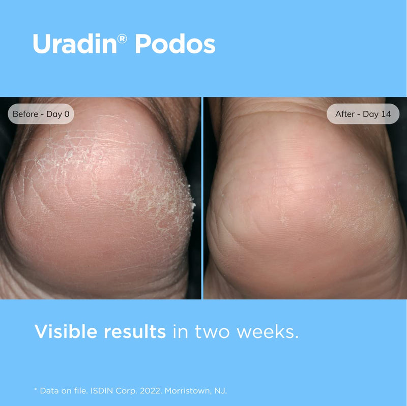 ISDIN Uradin Podos Foot Cream, 10% Urea, Repairs Cracked Feet, 2.5 fl oz | Fast Absorbing & Lightweight Formula, Hydrates Dry Feet, Exfoliates Thick Skin, Non-greasy, Dermatologist Recommended