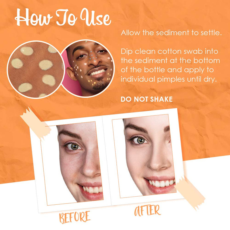Bye Bye Blemish Dark Spot Lotion Vitamin C | Assists with Drying Blemishes and Brightening Skin | Fast Acting Solution | 1 Fl Oz 1 Fl Oz (Pack of 1)