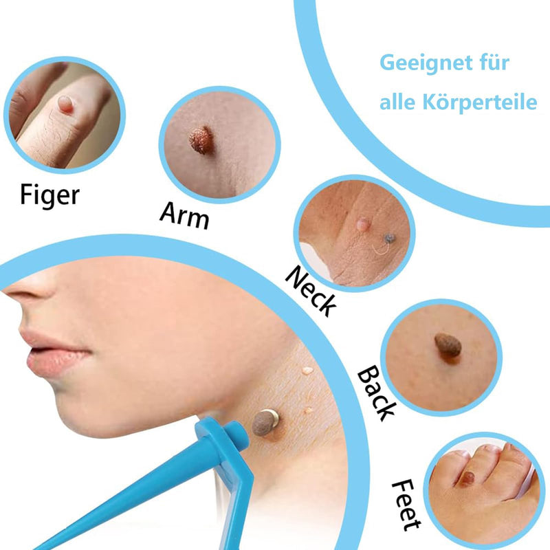 [Australia] - Tag Remover Device, Stalk Wart Removal Device, 3 in 1 Skin Tag Fibroma Removal Quick Kit, Safe for Face, Neck and Body Azure Blue 
