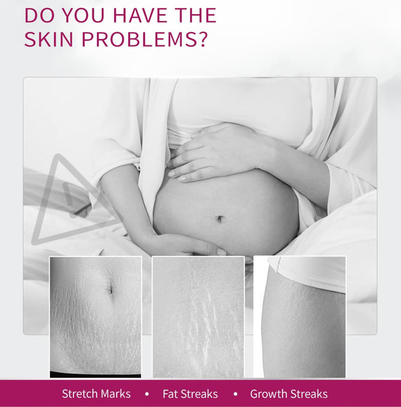 [Australia] - Stretch Mark Removal Cream, Obesity Stretch Mark Moisturizer, Postpartum Repair Stretch Mark Cream, Abdominal Stretch Mark Cream, Remove Marks (1 PCS) 1 PCS 
