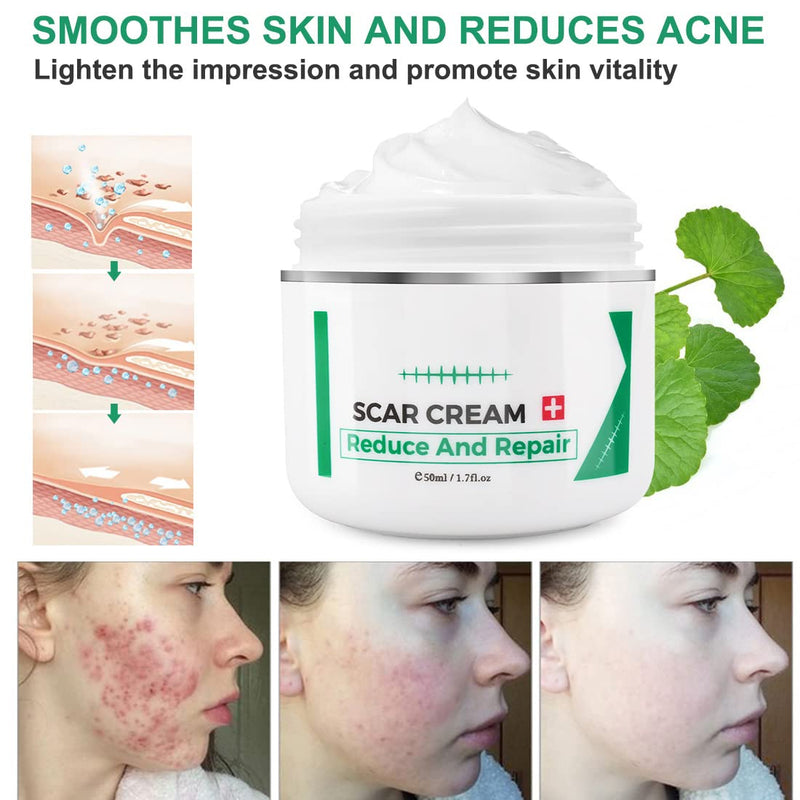 [Australia] - Scar cream, scar removal cream, advanced scar treatment gel for surgical scars, acne scars, effective for old and new scars 