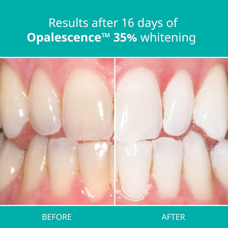 Opalescence 35% Gel Syringes Teeth Whitening - Refill Kit (2 Packs / 4 Syringes Total) Carbamide Peroxide. Made by Ultradent, in Mint Flavor. Tooth Whitening Refill Syringes 5197-2