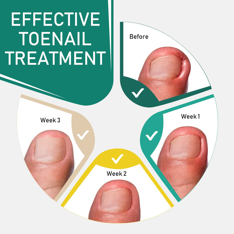 Nail Care Patches, Gentle Adhesive Design, Invisible Comfort, Easy to Apply, Breathable Material, Suitable for Daily Toenail & Fingernails