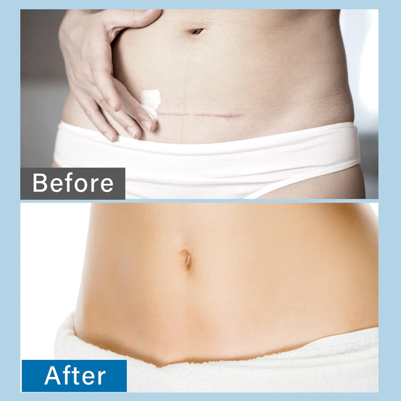[Australia] - Scar ointment, premium scar gel, effective for keloid scar treatment, reduces tissue tension and itching 