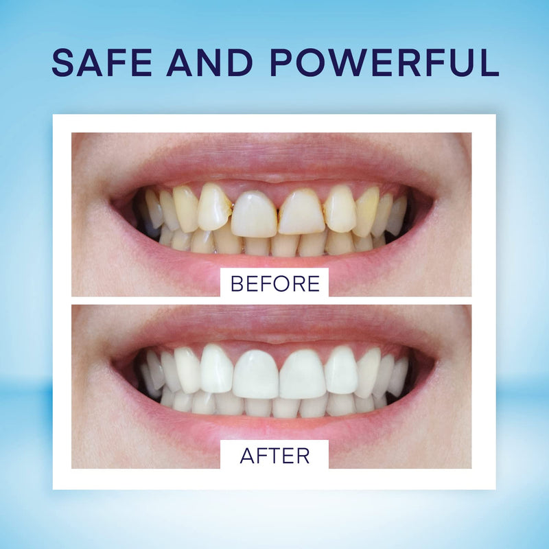 [Australia] - Teeth Whitening Pen (4 Pens) for Teeth Whitening, 40+ Uses, Effective, Painless, No Sensitivity, Travel-Friendly, Beautiful White Smile, Mint Flavor 