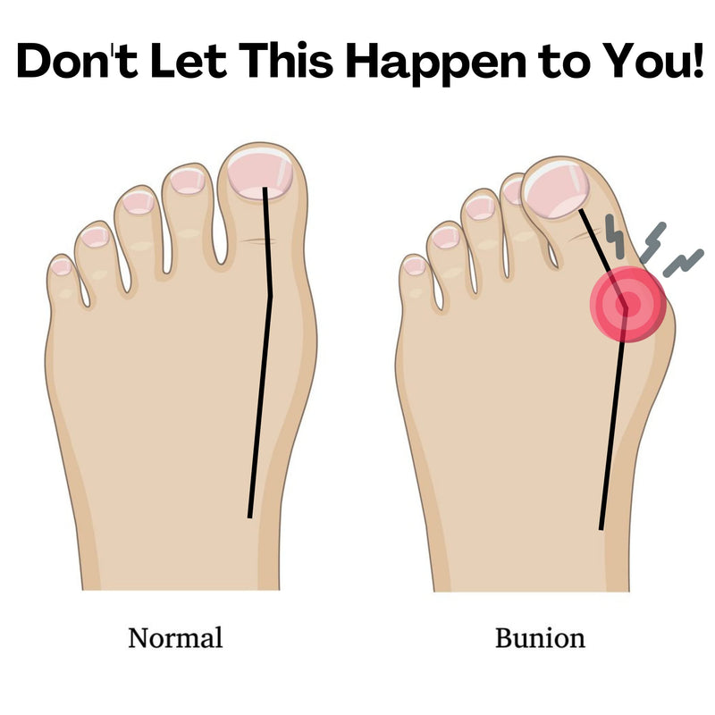 [Australia] - Toe Separators for Foot Alignment- Strengthening and Balance- For Hammertoes, Bunions, Plantar Fasciitis, Hallux Valgus – Spreaders- Size Large (1 pair) 