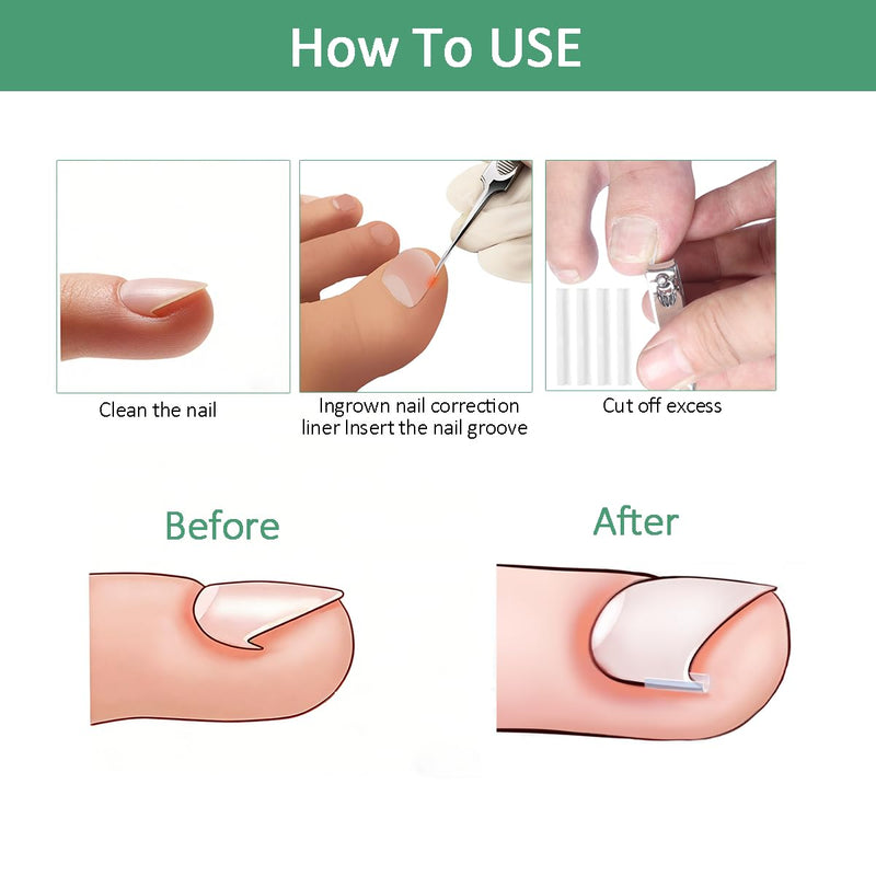 Professional Ingrown Toenail Treatment Set with Breathable Ingrown Toenail Strips,Ingrown Toenail Removal Kit,Curved Toenails Corrector Patch, Ingrown Toenail Corrector Tool Set for Home Use