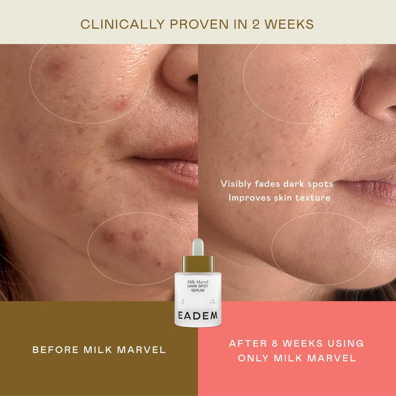 EADEM Dark Spot Remover Serum for Face Infused with Vitamin C & Niacinamide | Milk Marvel, Helps Fade Hyperpigmentation, Minimizes the Look of Pores, Made for All Skin Tones, Dark Spot Corrector, 1.01oz