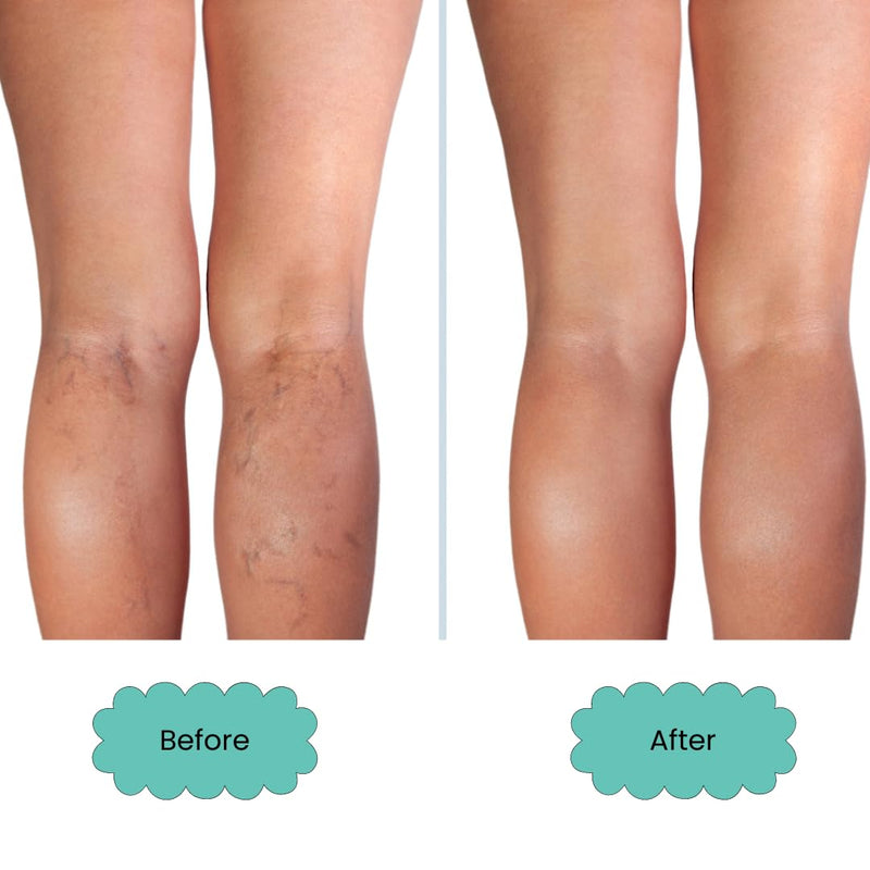 [Australia] - Clearly VEIN - Natural varicose veins and spider veins treatment with essential oils and herbal extracts from horse chestnut and helichrysum - For healthy capillaries on the face, legs and body 