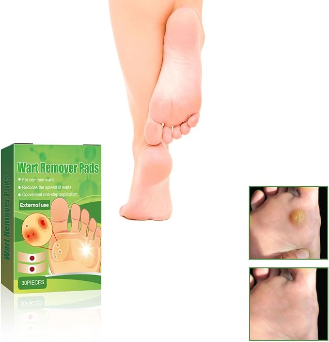WABRINY Wart Remover Pads, Maximum Strength One Step Bandages for Hands Neck Feet Fingers, 30 Treatments-RK 30 Count (Pack of 1)