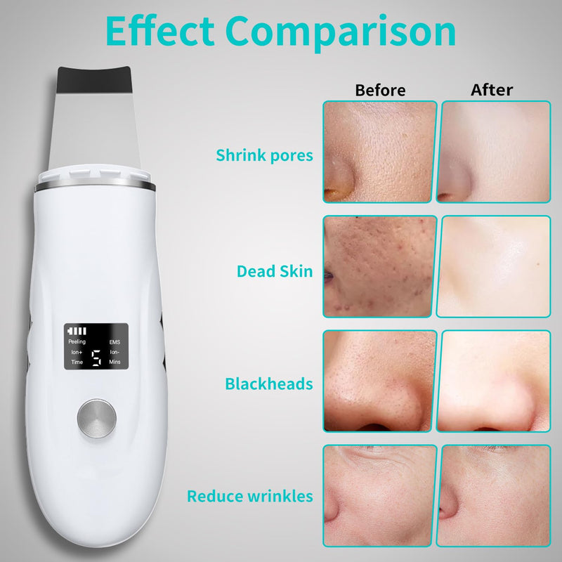 Face Scrubber Skin Spatula - Blackhead Remover Deep Cleansing Tool for Pore Extraction, 4-in-1 Fast Charging Dock Blackhead Remover Face Spatula for Facial Skincare Women Gift (White) White