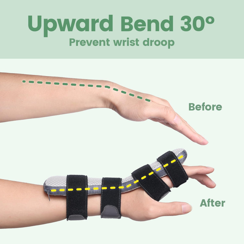 Radial Nerve Palsy Splint for Wrist Drop, Adjustable Static Fingers Fixation Brace, for Crutch Palsy, Limp Finger, Mcp Arthroplasty, Stroke Hand Recovery - Fits Right & Left Hand