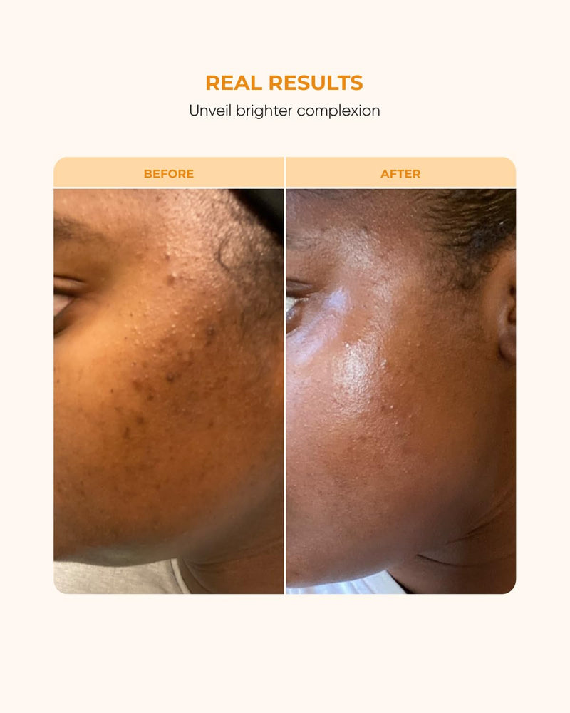 Buttah Skin 15% Vitamin C Serum 1 FL oz 30mL - For Uneven Skin Tone - Ferulic Acid - Anti-Dark Spot Vitamin C Serum For Face